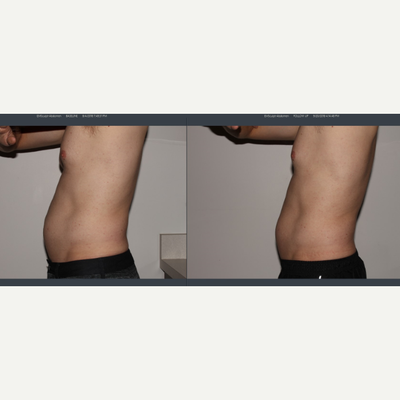 Emsculpt before and after photo