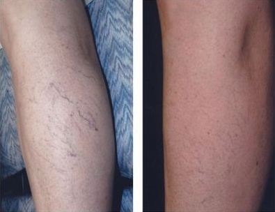 Sclerotherapy before and after photo
