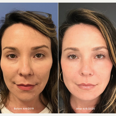 Voluma before and after photo