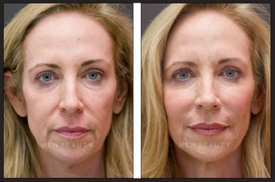 Botox before and after photo