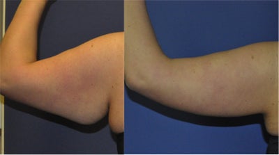 Arm Lift before and after photo