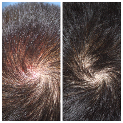 PRP for Hair Loss before and after photo