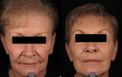 Botox before and after photo