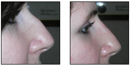 Nonsurgical Nose Job before and after photo