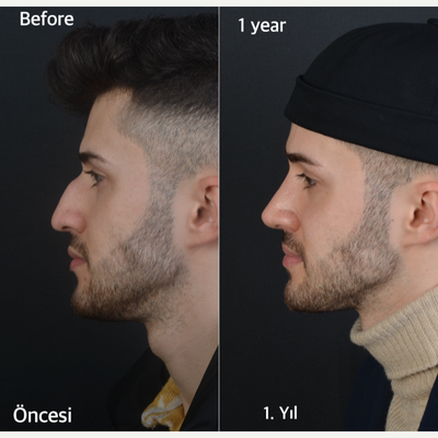Septoplasty before and after photo
