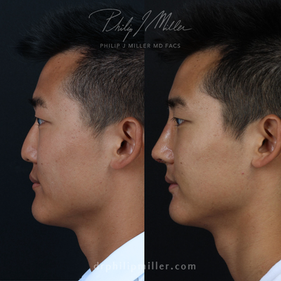 Asian Rhinoplasty before and after photo