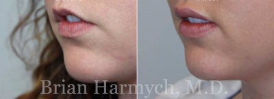 Restylane before and after photo