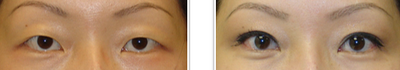 Eyelid Surgery before and after photo