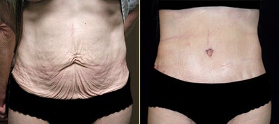 Tummy Tuck before and after photo