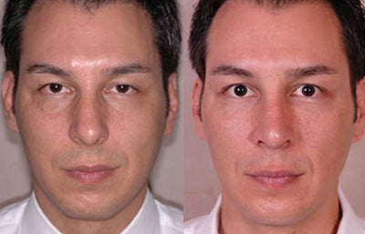 Facial Fat Transfer before and after photo
