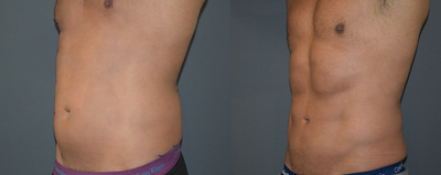 Vaser Liposuction before and after photo
