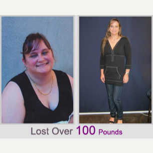 Lap Band before and after photo