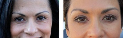 Juvederm before and after photo