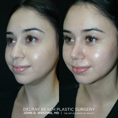 Rhinoplasty before and after photo