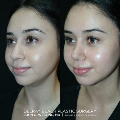 Rhinoplasty before and after photo