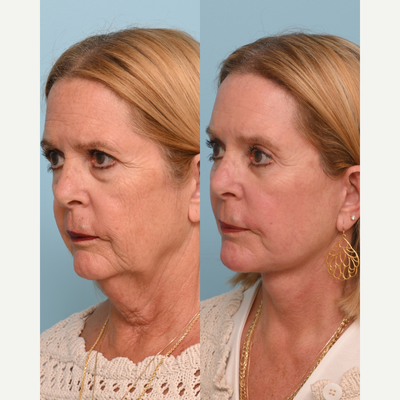 Buccal Fat Removal before and after photo