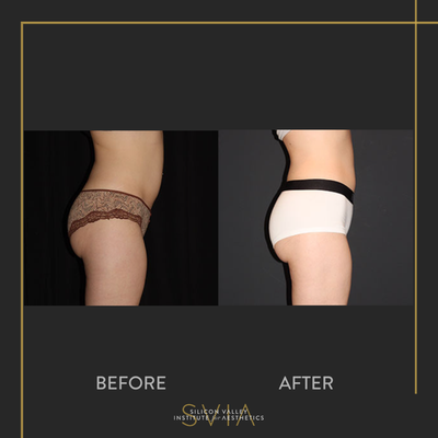 Liposuction before and after photo