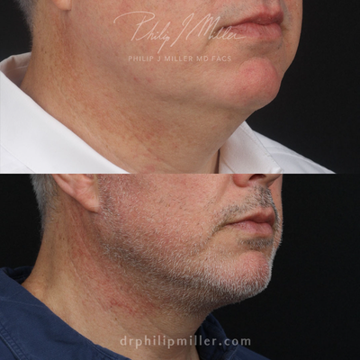 Chin Liposuction before and after photo