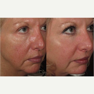 Halo Laser before and after photo