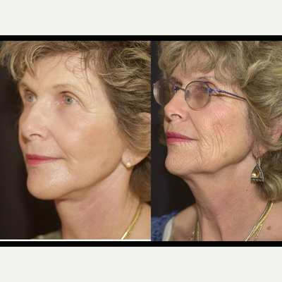 Facelift before and after photo