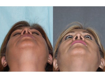 Revision Rhinoplasty before and after photo