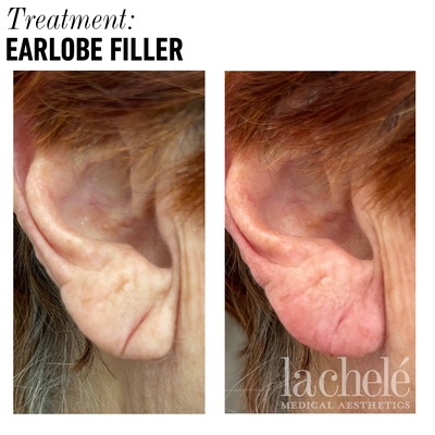 Dermal Fillers before and after photo