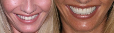 Porcelain Veneers before and after photo