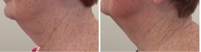 ThermiSmooth Face before and after photo