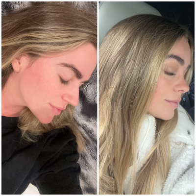 Rhinoplasty before and after photo