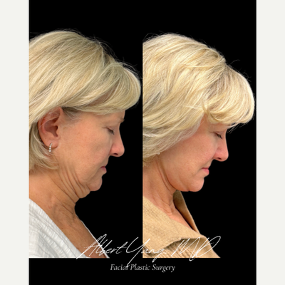 Facelift before and after photo