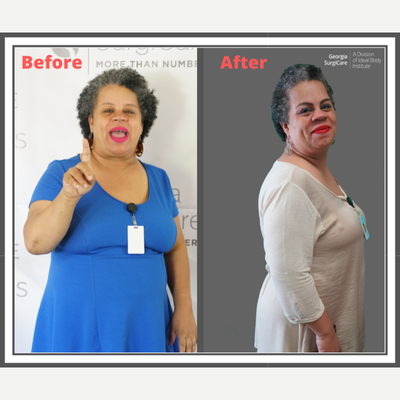 Orbera Gastric Balloon before and after photo