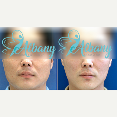 Fraxel Laser for undereye bags  Albany Laser & Cosmetic Center