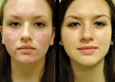 IPL before and after photo