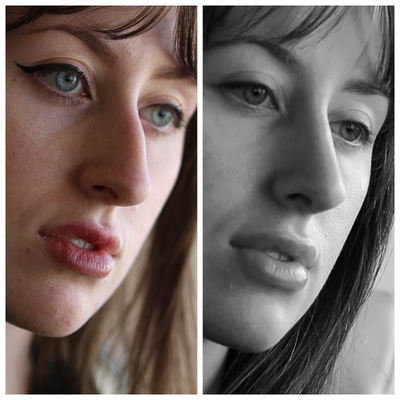 Rhinoplasty before and after photo