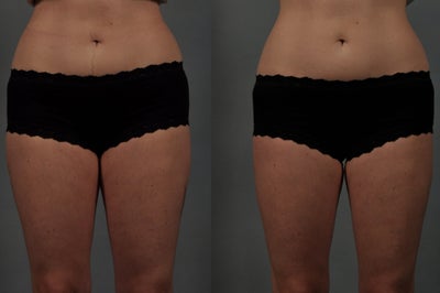 CoolSculpting before and after photo