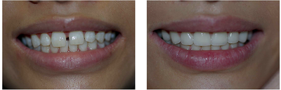 Porcelain Veneers before and after photo