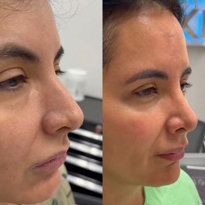 Rhinoplasty before and after photo