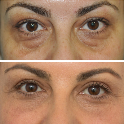 Eyelid Surgery before and after photo