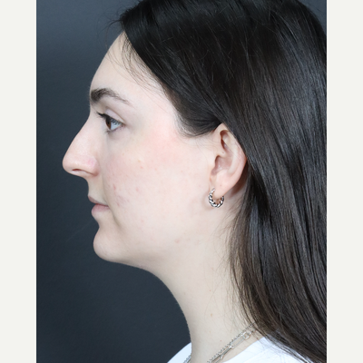 Deep Neck Lift, Dr. Anil Shah, Shah Aesthetics, Chicago, IL