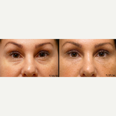 Restylane before and after photo