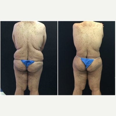 Body Lift before and after photo
