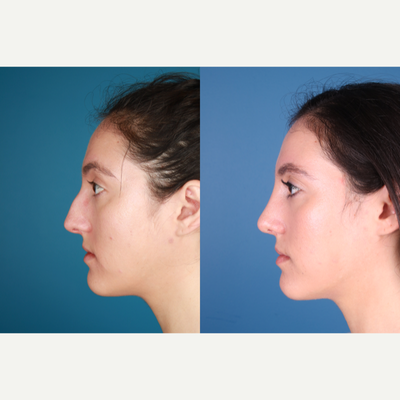 Rhinoplasty before and after photo