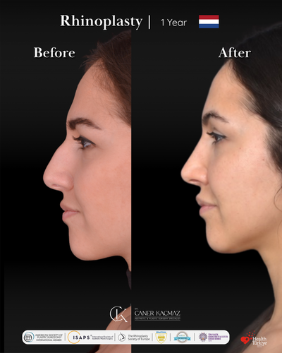 Rhinoplasty before and after photo