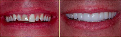 Smile Makeover before and after photo