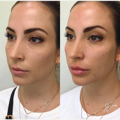 Dermal Fillers before and after photo