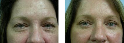 Eyelid Surgery before and after photo
