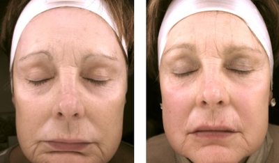 Juvederm before and after photo