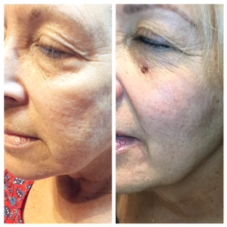 Microneedling before and after photo
