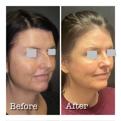 Rhinoplasty before and after photo