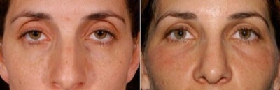 Facial Fat Transfer before and after photo
